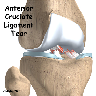 knee_acl_intro01