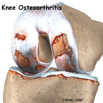 knee_osteoarth_intro01