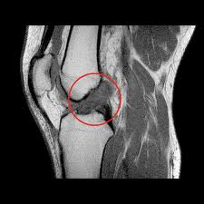 Patologia Legamentosa Ginocchio (LCA – LCP)